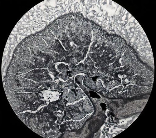Karcinom: Razumevanje bolesti i prirodni pristupi podršci organizmu
